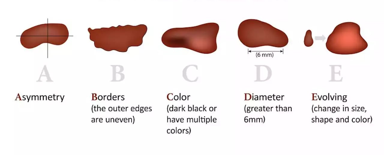 The ABCDE criteria: asymmetry, border, colour, diameter and evolving, each illustrated with a benign and a malignant lesion