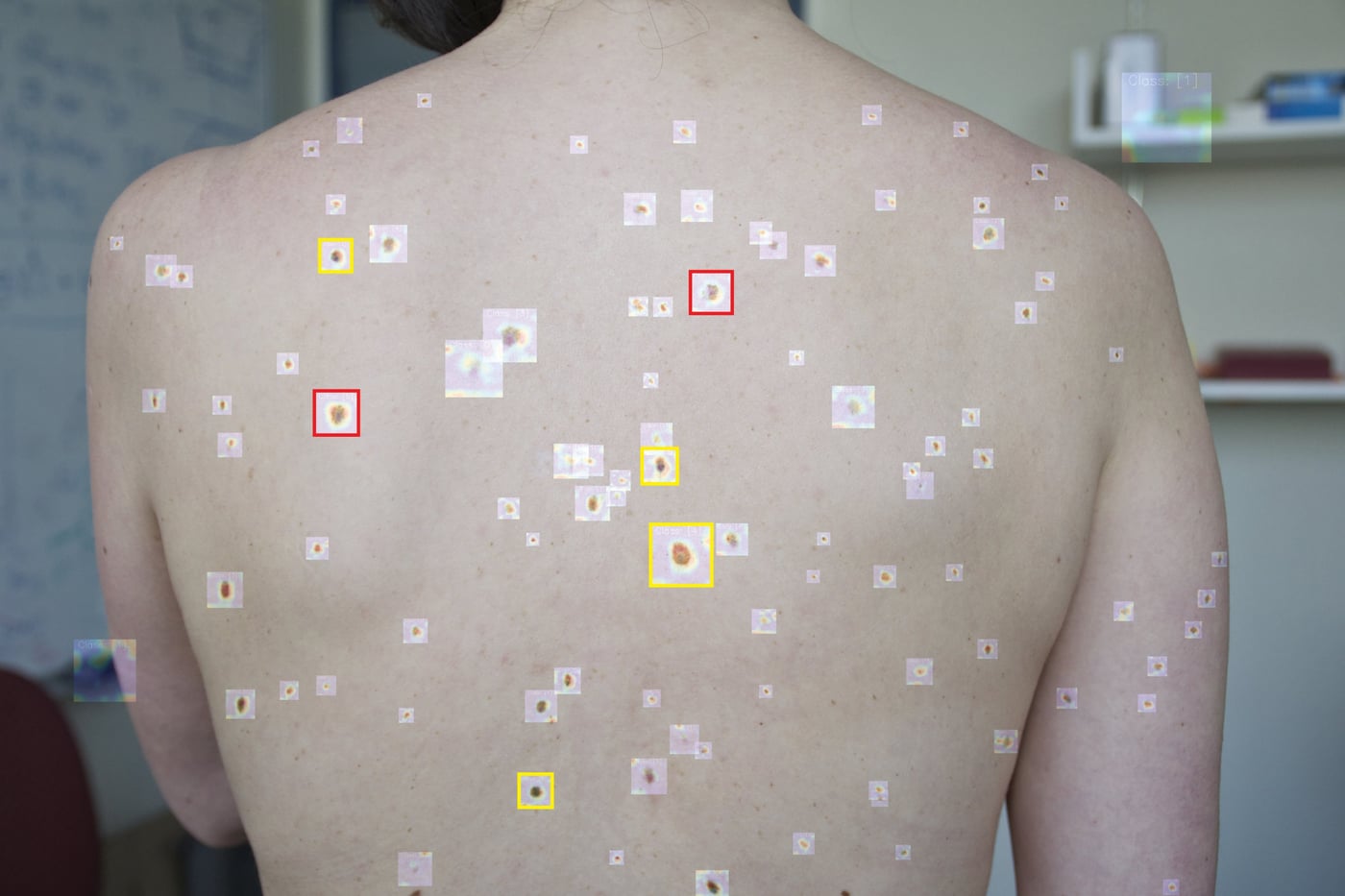 A dermatoscopic lesion being tracked by a real-time detection system