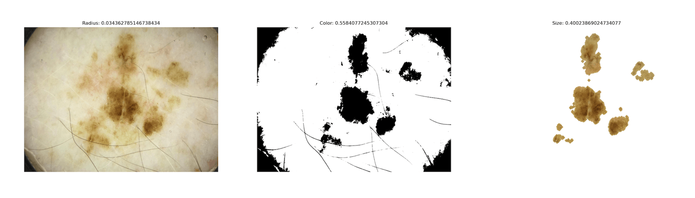 The same three preprocessing stages for a second lesion, with its own radius, colour and size metrics