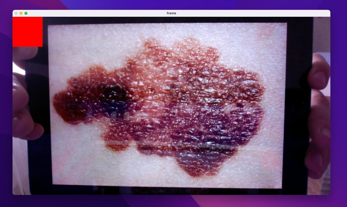 A photograph of a melanoma held up to the webcam on a tablet, the rectangle now red